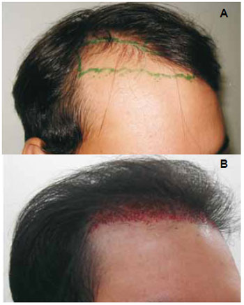Long Hair FUE vs. FUE Tradicional: Qual a Melhor Opção para Você?