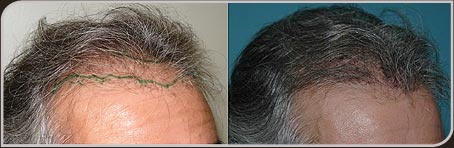 Guia Completo de Preços do Transplante Capilar no Brasil