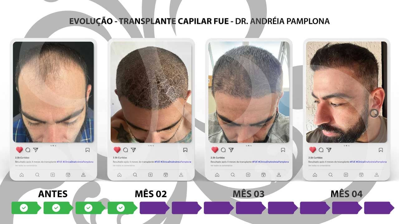O Que Esperar Após um Transplante Capilar com Fios Longos?