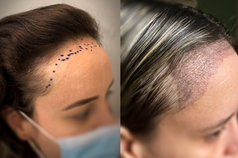 Transplante capilar com fios longos valor