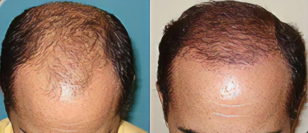 Transplante Capilar Fios Longos: O Que Você Precisa Saber Antes de Fazer