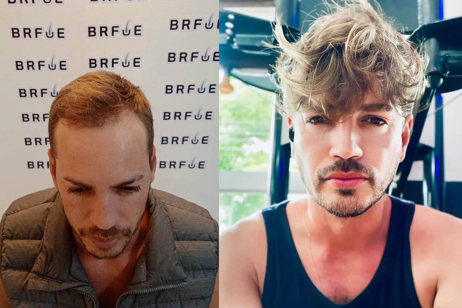 Long Hair FUE vs. FUE Tradicional: Qual a Melhor Opção para Você?