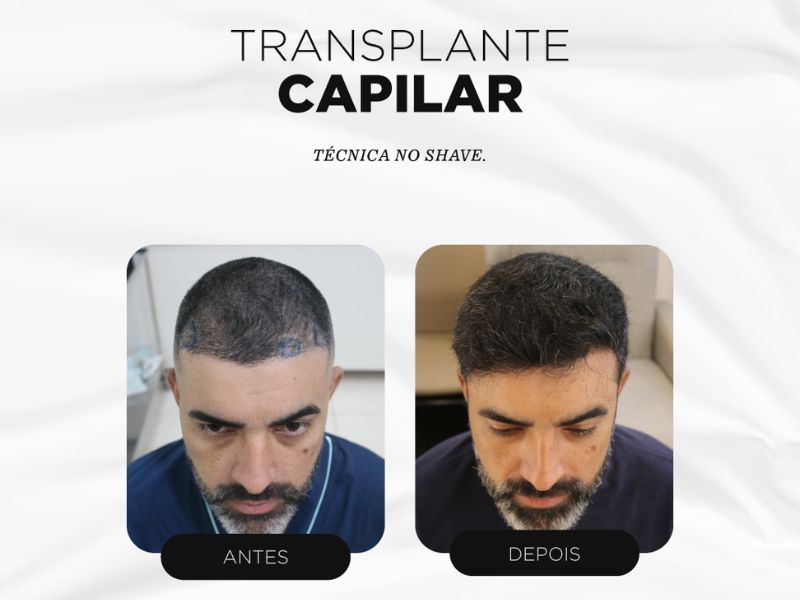 Guia Completo de Preços do Transplante Capilar no Brasil