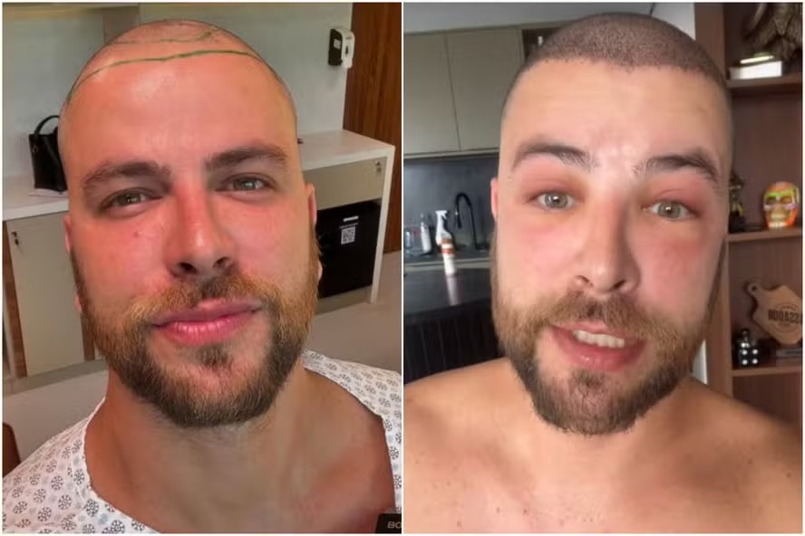 Transplante capilar em cicatrizes preço