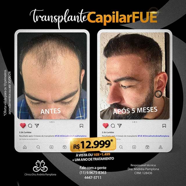 Como Otimizar a Taxa de Sucesso do Transplante Capilar em Cicatrizes