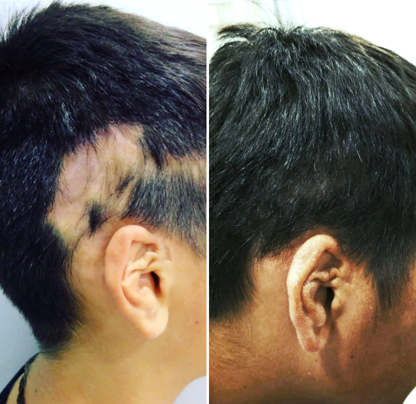 Desafios e Soluções do Transplante Capilar em Tecido Cicatricial