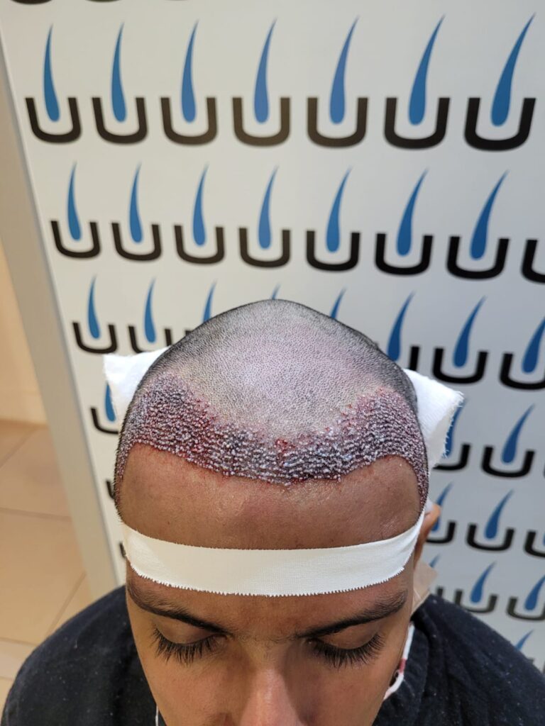 Guia Completo: Entendendo os Fatores de Custo do Transplante Capilar