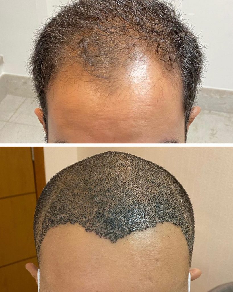 FUE vs FUT: Qual a Melhor Técnica para Cicatrizes?