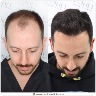 Transplante Capilar Foz do Iguaçu: Guia Completo de Preços e Clínicas