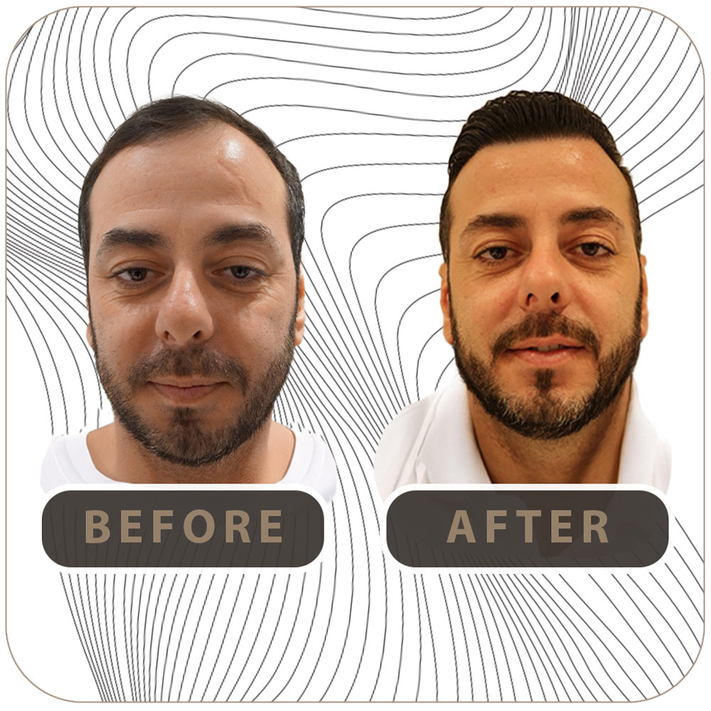 FUE vs DHI: Qual a Melhor Técnica de Transplante Capilar para Você?