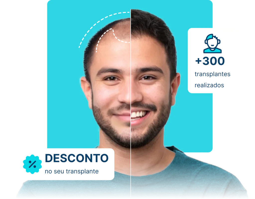 Transplante capilar em Foz do Iguaçu valor