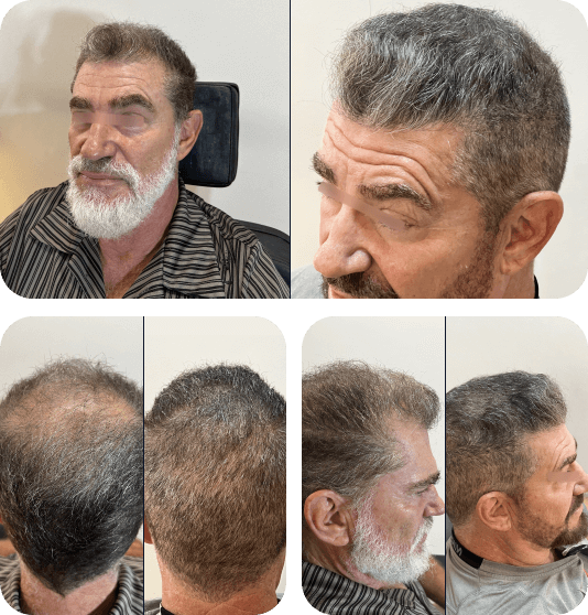 Transplante Capilar Foz do Iguaçu: Guia Completo de Preços e Clínicas