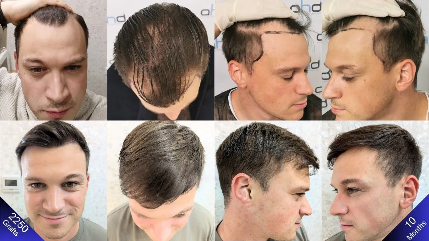 Transplante capilar em Moinhos de Vento RS