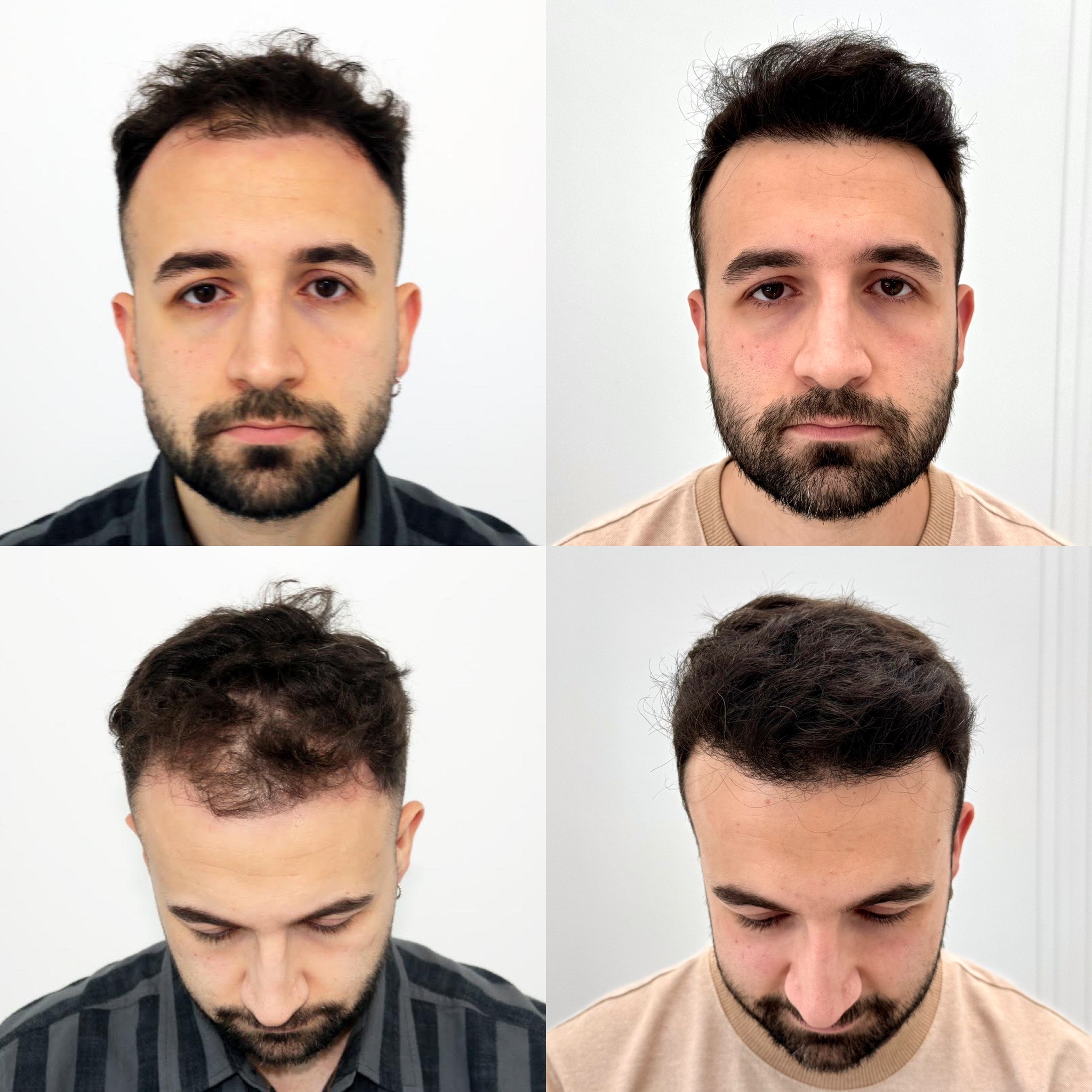 Transplante capilar em Moinhos de Vento RS