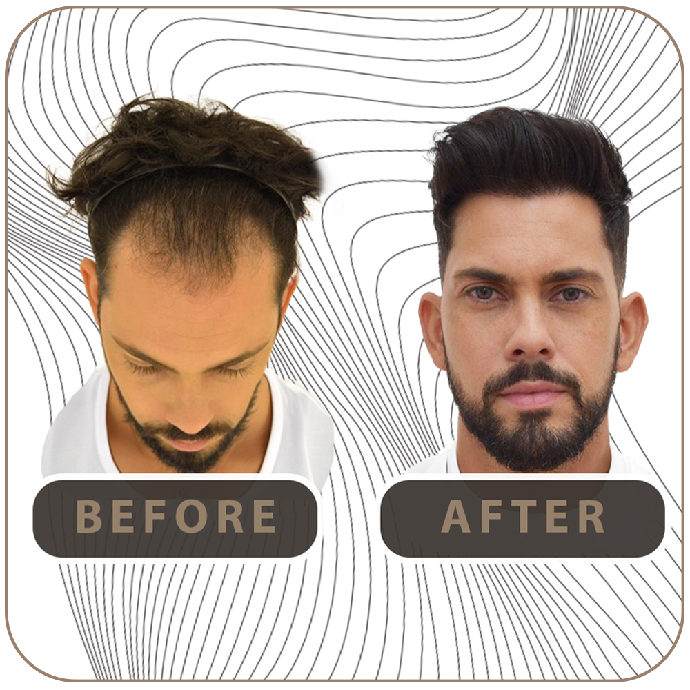 Transplante capilar em Niterói preço