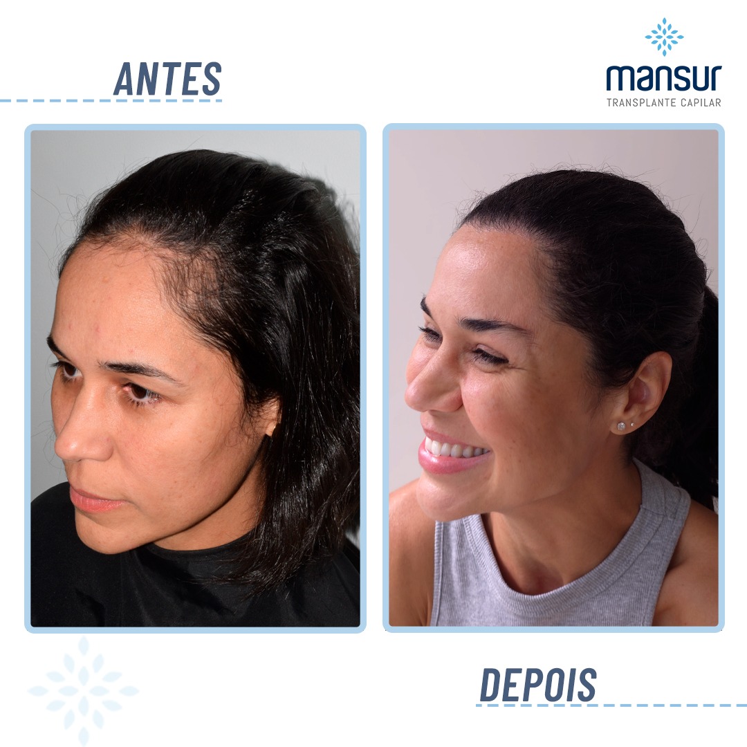 Transplante capilar em Niterói preço