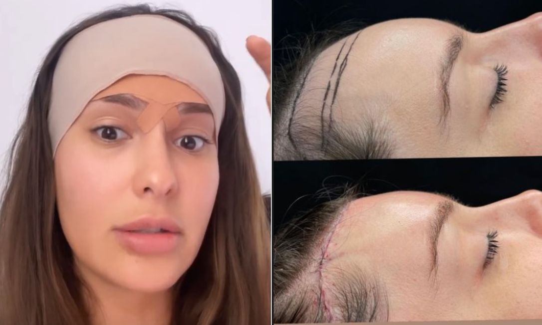 Transplante capilar para testa grande preço