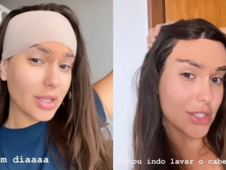 Técnica FUE vs. FUT: Qual a Melhor para Diminuir a Testa?