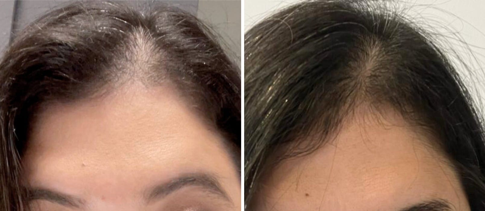 Entenda as Causas da Queda de Cabelo e Como Tratá-la em Olinda