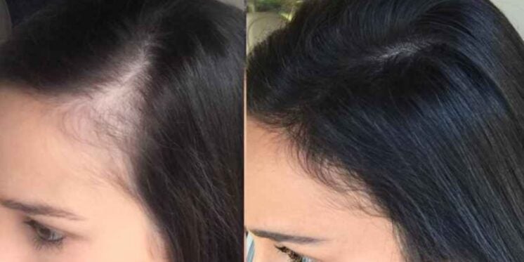 Terapia Capilar vs. Dermatologia: Qual a Melhor Opção para Você em Olinda?