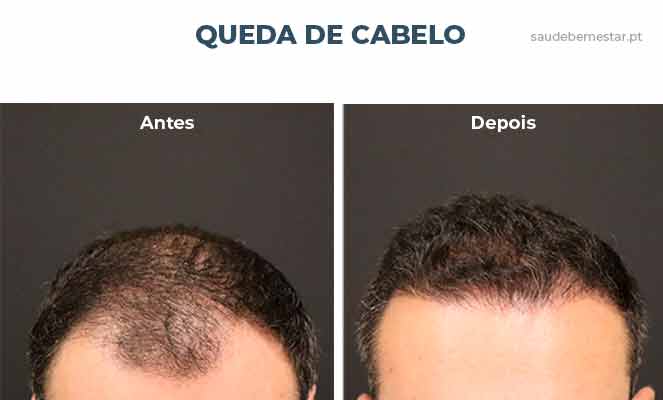 Tratamento Para Queda De Cabelo