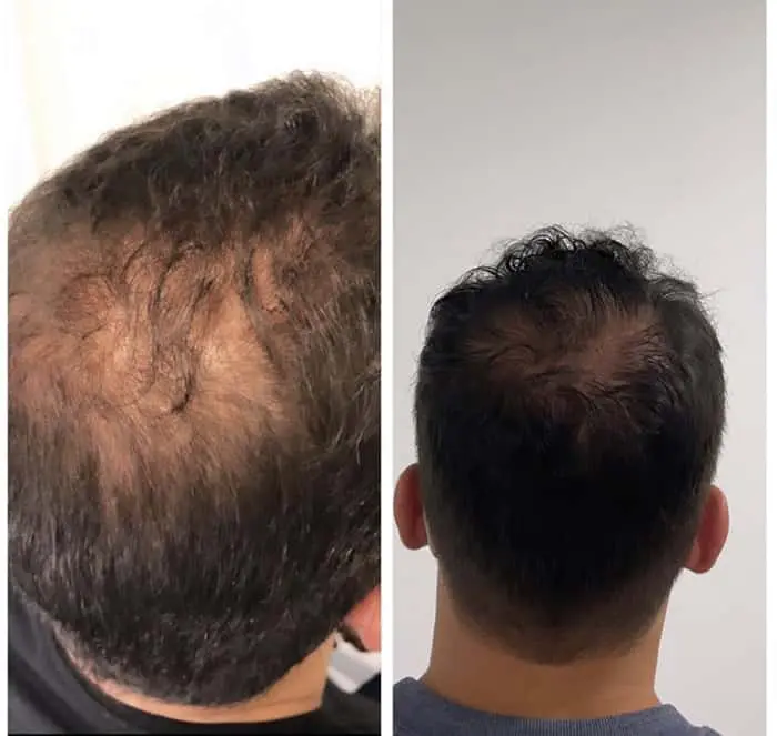 Novidades 2026: PP405 e Clascoterona Revolucionam o Tratamento da Calvície