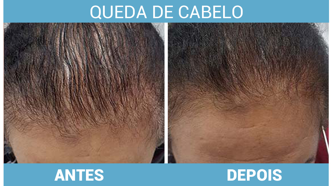 Guia Completo de Procedimentos Dermatológicos para Queda Capilar: MMP, Mesoterapia e PRP