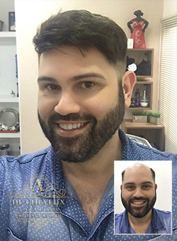 Valor de implante capilar em Arapiraca