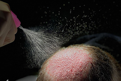 Valor de implante capilar em Gravataí