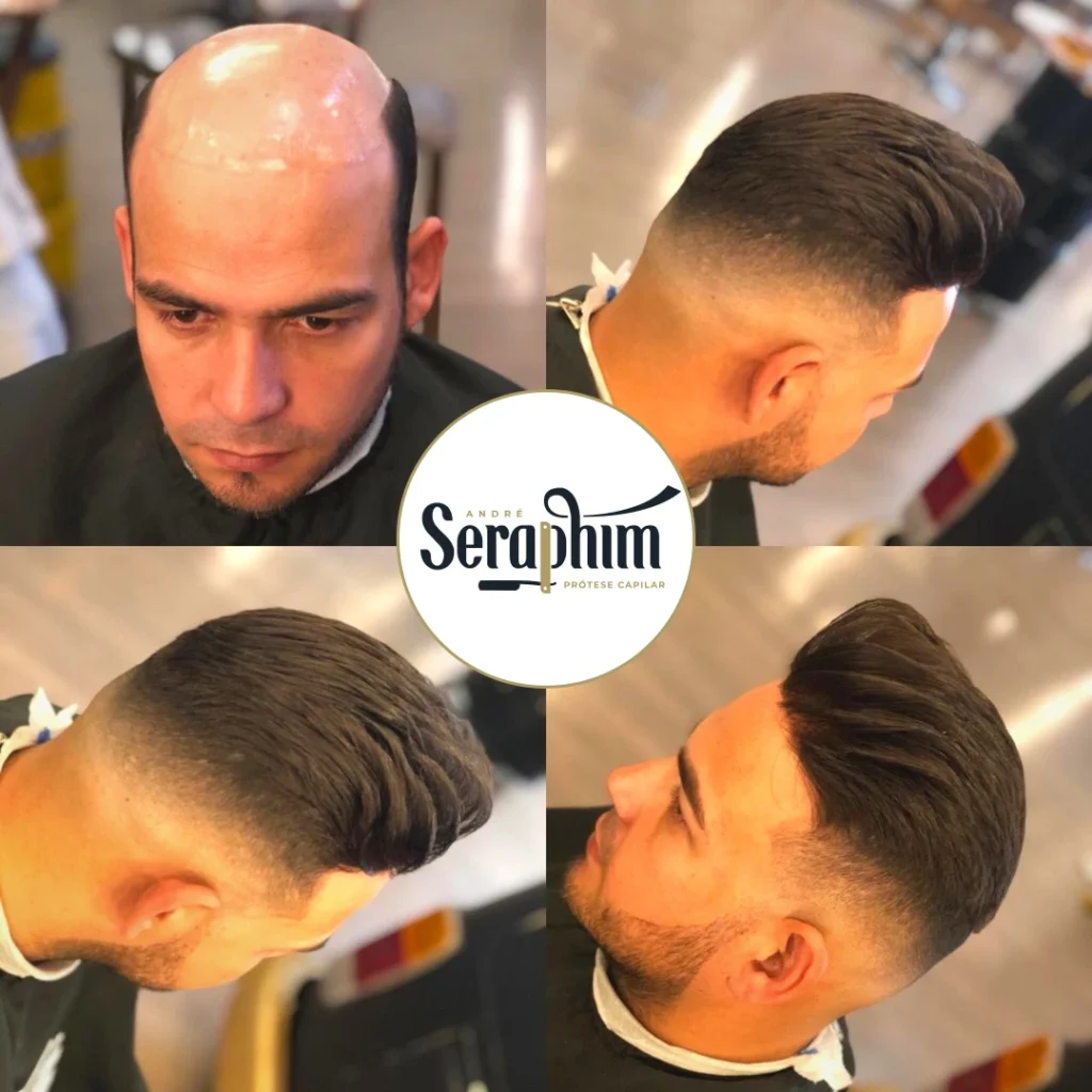 Prótese Capilar: Entenda a Diferença de Preços entre Manutenção Profissional e Caseira