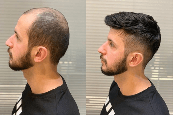 Manutenção de Prótese Capilar: Frequência Ideal e Cuidados Essenciais