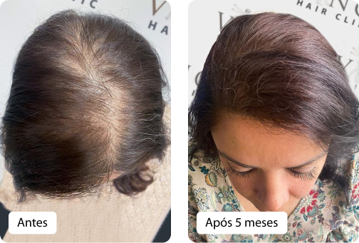 Vinci Hair Clinic preços tratamentos